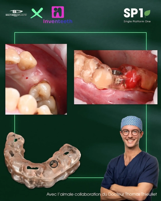 Chirurgie dentaire avec implants et gouttière.