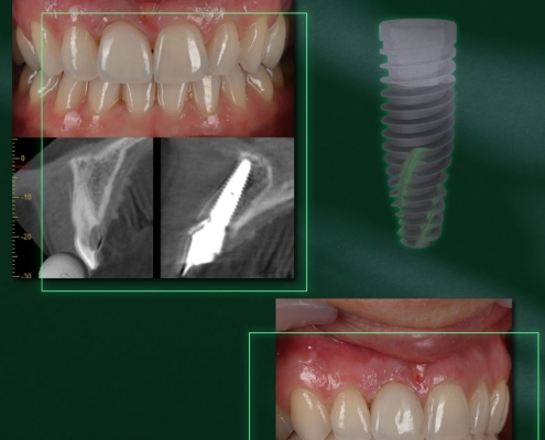 Implant dentaire simple avec prothèse, vue avant et après.
