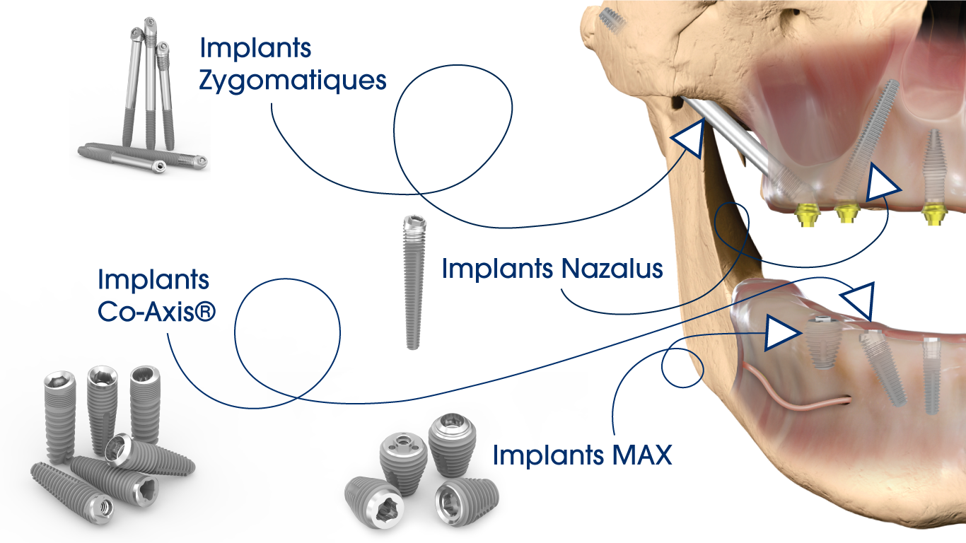 Différents types d'implants dentaires illustrés.