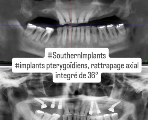 Radiographie dentaire avec implants pterygoïdiens.