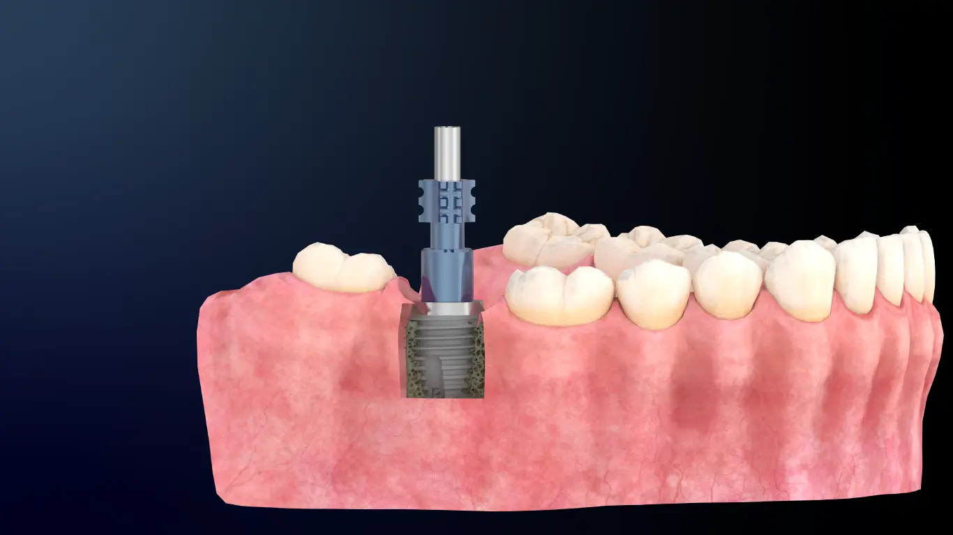 illustration secteur posterieur Implant dentaire inséré dans la gencive.