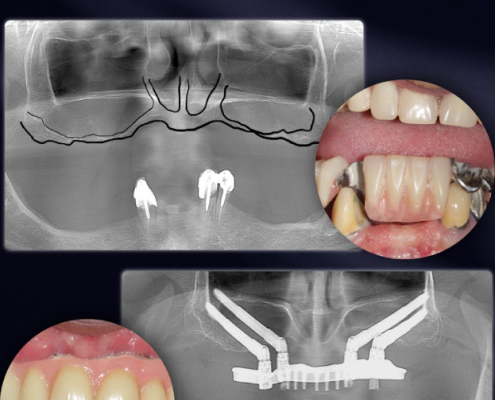Radiographies dentaires et implants avec Quad Zygoma.