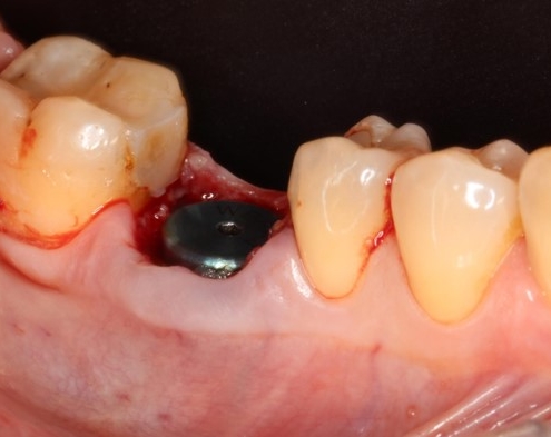 Implant dentaire visible dans la gencive inférieure.