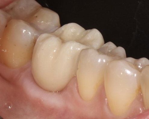 Vue rapprochée de dents humaines rangées