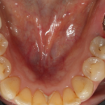 Vue dentaire inférieure avec implant visible.