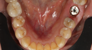 Pose implant MAX Vue dentaire inférieure avec implant visible.