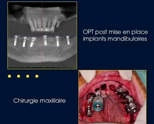 Radiographie implants mandibulaires et image chirurgie maxillaire.