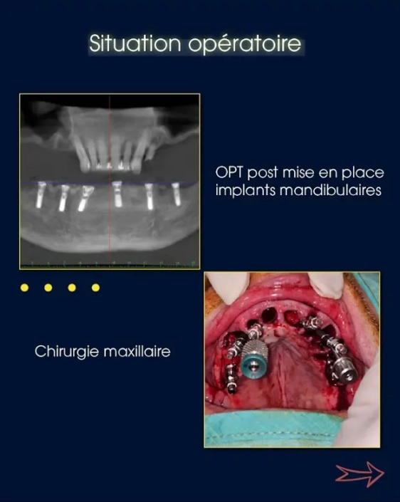 Radiographie implants mandibulaires et image chirurgie maxillaire.