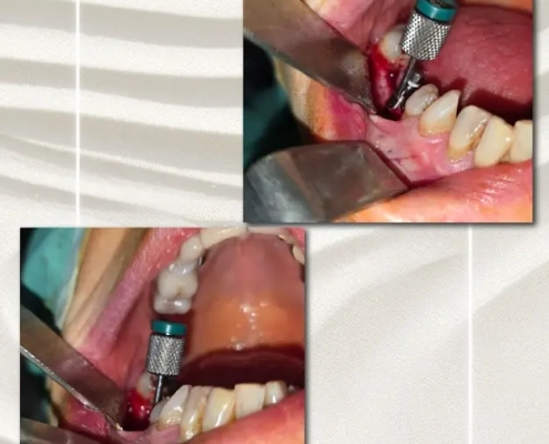 cas clinique dr. benat 3 Implant dentaire en cours d'installation dans la bouche.