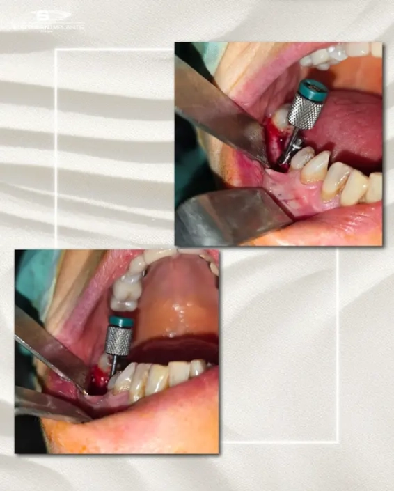 cas clinique dr. benat 3 Implant dentaire en cours d'installation dans la bouche.