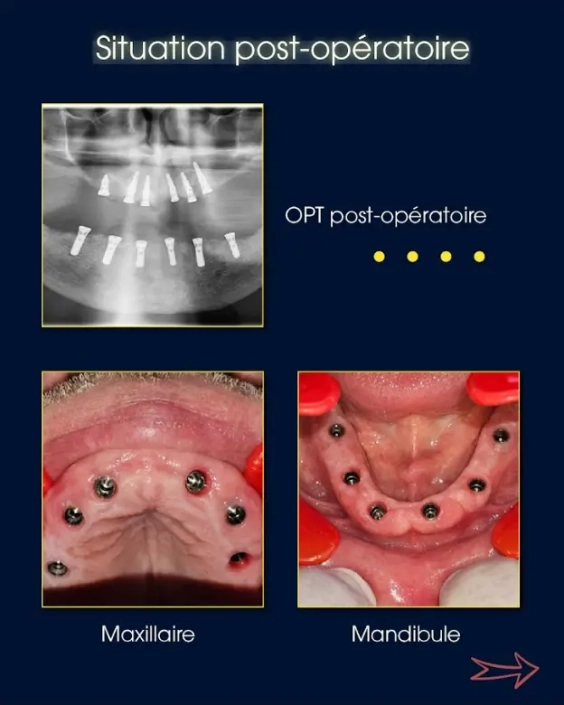 Images dentaires du maxillaire et de la mandibule post-opératoires.