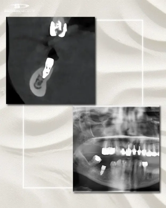 cas clinique dr. benat 4 Radiographies dentaires avec implants visibles.