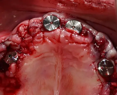 Implants dentaires chirurgicaux en bouche ouverte.