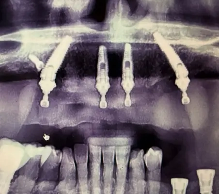 Radiographie dentaire avec implants visibles