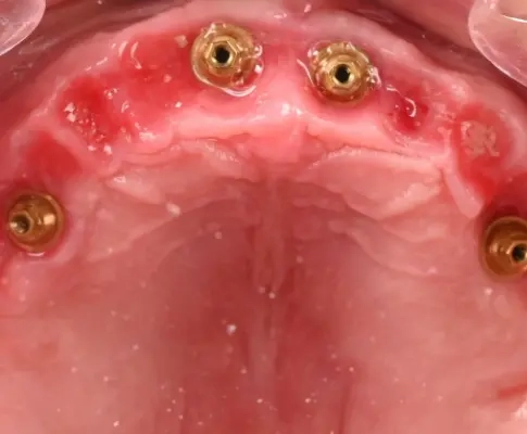 Implants dentaires dans la mâchoire supérieure.