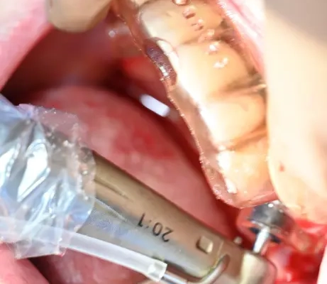 Intervention dentaire avec outil professionnel.