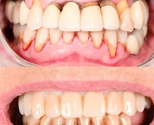 Comparaison avant-après de soins dentaires.