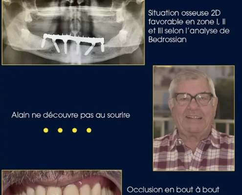 Radiographie dentaire et homme souriant avec prothèse.