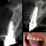 Radiographie dentaire et dents montrées en gros plan.