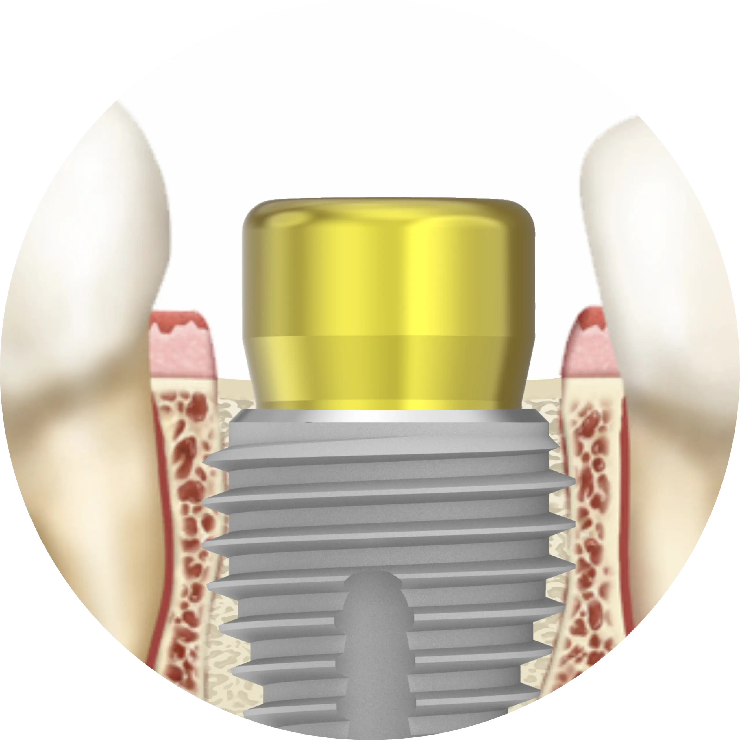 Schéma d'implant dentaire avec couronne.